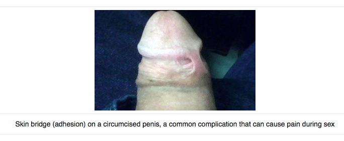 Penile adhesions, also called skin bridges, are a common circumcision complication.