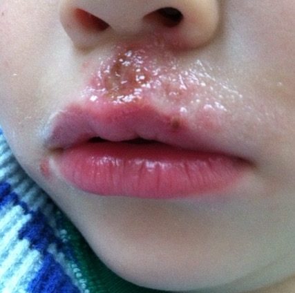 After my son had a bad reaction to the Hib vaccine, he started getting rashes several times a year. Via JenniferMargulis.net