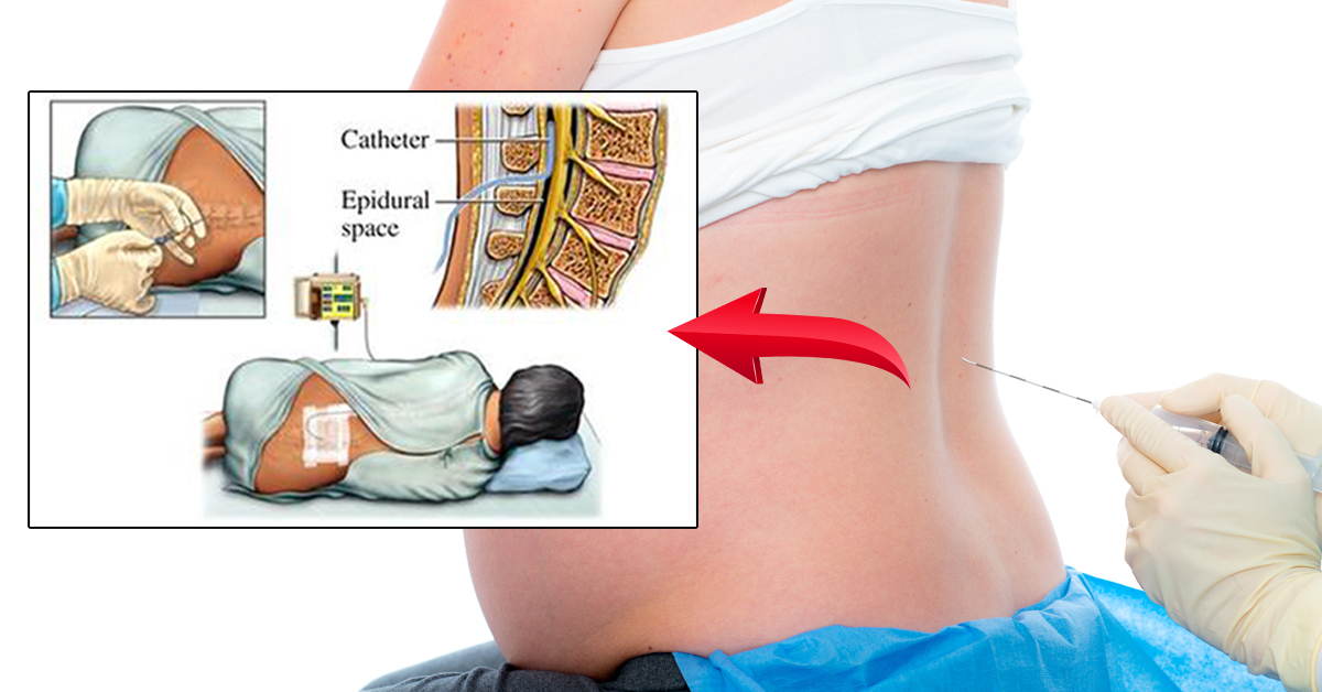 Spinal epidural being inserted into the lumbar region. [Image via MomJunction]