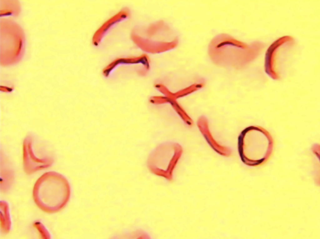 What's the Microbiome? Article by Jennifer Margulis. Photo of Babesiosis, a disease caused by microscopic parasites that infect red blood cells | photo courtesy of Dr. Morten Laane, Norway
