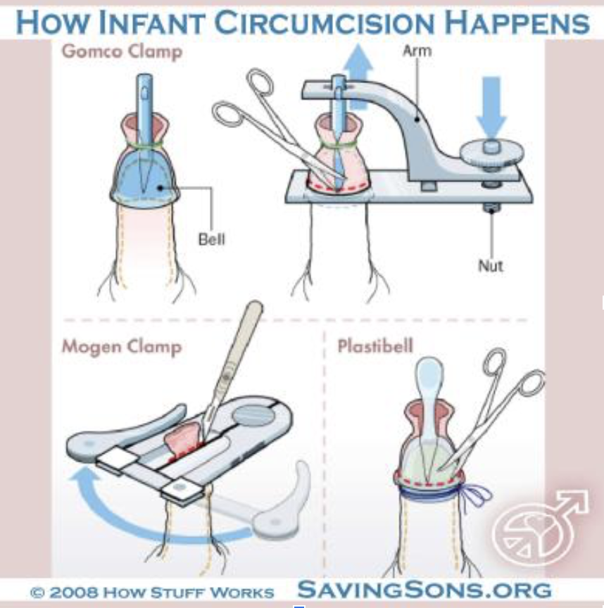 Graphic showing how infant circumcision happens. Shows the three devices used: Gomco Clamp, Mogen Clamp, and Plastibell.