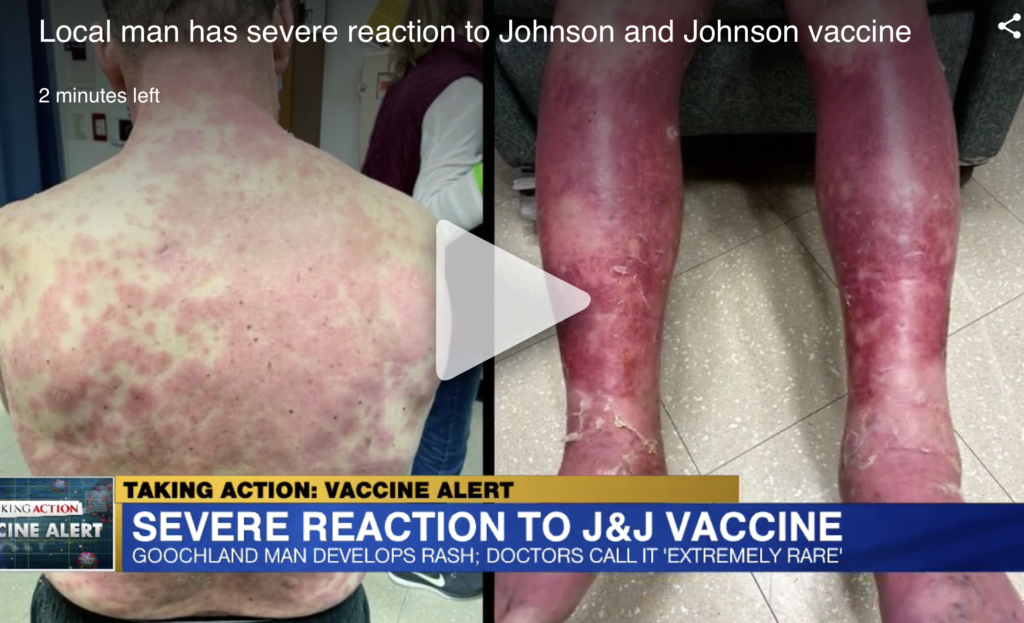 A Virginia man spent 5 days in hospital after suffering a severe reaction to Covid-19 vaccine. Screenshot of his red rash and peeling off skin from an interview with WRIC News. | Jennifer Margulis, Ph.D.